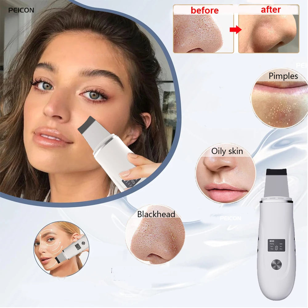 Espátula ultrasónica para el cuidado de la piel, eliminador de puntos negros y espinillas, depurador ultrasónico de la piel, espátula de limpieza Facial profunda para el cuidado de la cara