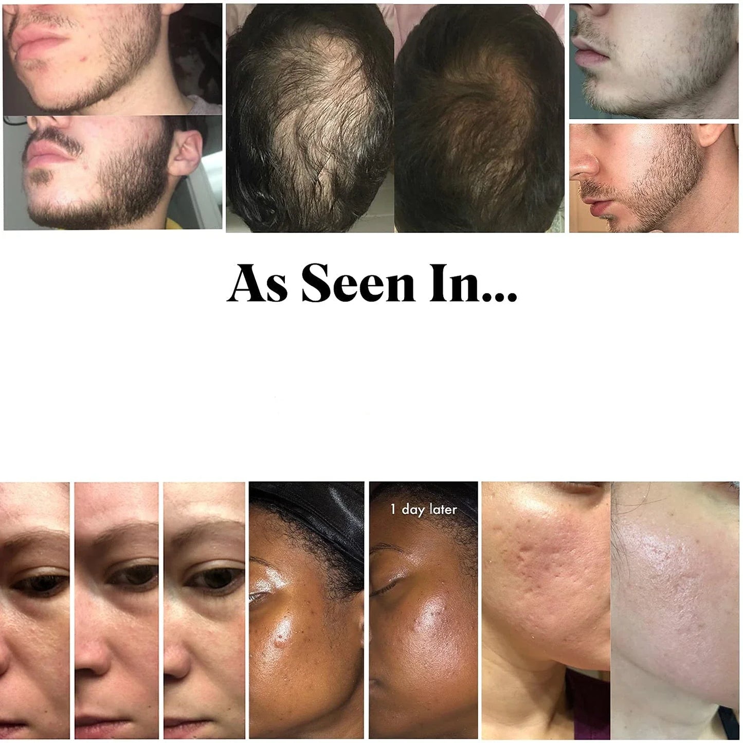 Rodillo Derma 540, aguja para el cuidado de la piel, Micro Dermaroller, rodillo Derma profesional para el crecimiento del cabello, rodillo de belleza Facial para el crecimiento de la barba